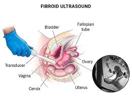12-24 Week Fibroid Healing Coaching Program