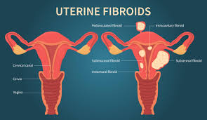 12-24 Week Fibroid Healing Coaching Program