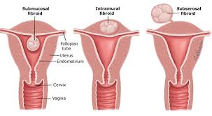 Discover Natural Relief from Fibroid Symptoms with a Free Consultation -