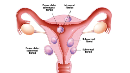 Discover Natural Relief from Fibroid Symptoms with a Free Consultation -