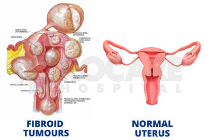 Discover Natural Relief from Fibroid Symptoms with a Free Consultation -